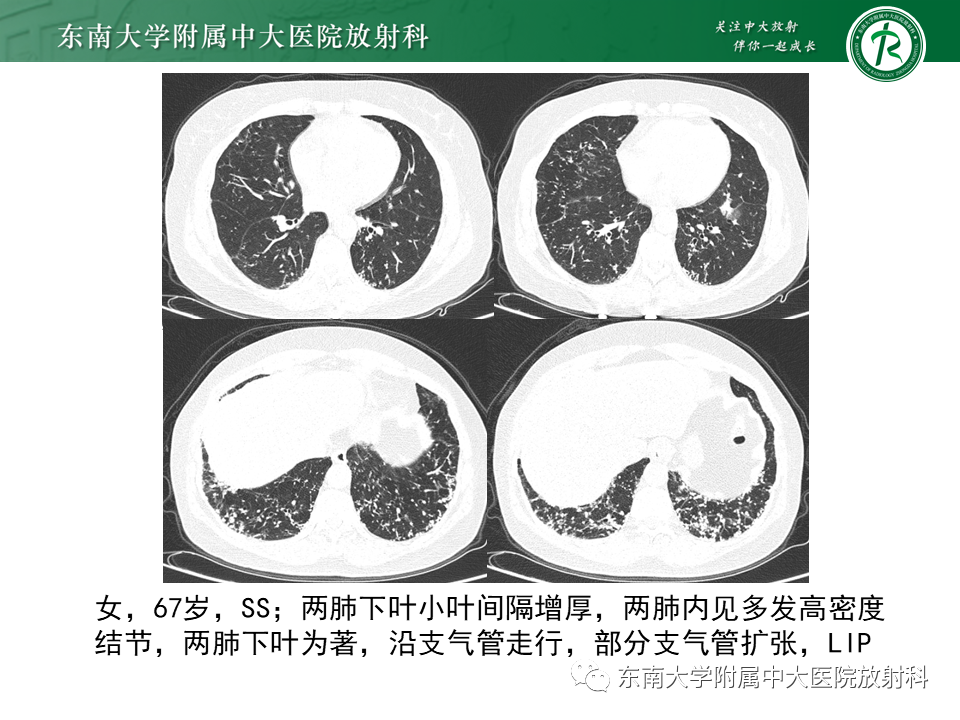 影像PPT - 【PPT】原发性干燥综合征的肺部改变-24 影像PPT - 【PPT】原发性干燥综合征的肺部改变-24