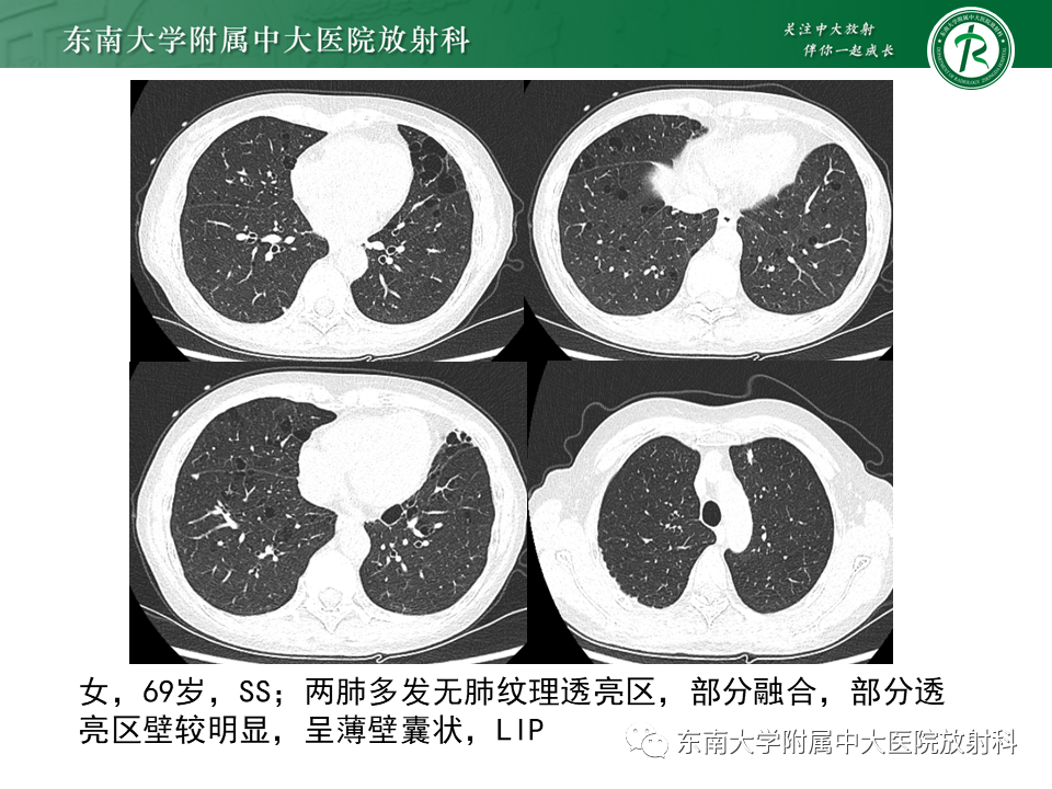影像PPT - 【PPT】原发性干燥综合征的肺部改变-22 影像PPT - 【PPT】原发性干燥综合征的肺部改变-22