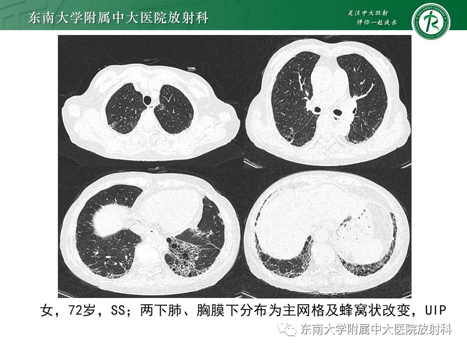 影像PPT - 【PPT】原发性干燥综合征的肺部改变-23 影像PPT - 【PPT】原发性干燥综合征的肺部改变-23