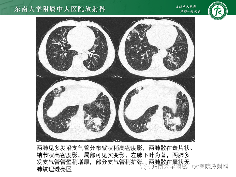 影像PPT - 【PPT】原发性干燥综合征的肺部改变-2 影像PPT - 【PPT】原发性干燥综合征的肺部改变-2