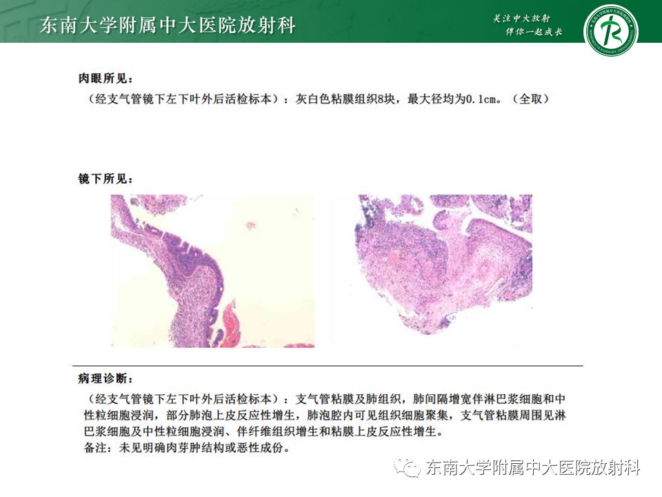 影像PPT - 【PPT】原发性干燥综合征的肺部改变-4 影像PPT - 【PPT】原发性干燥综合征的肺部改变-4
