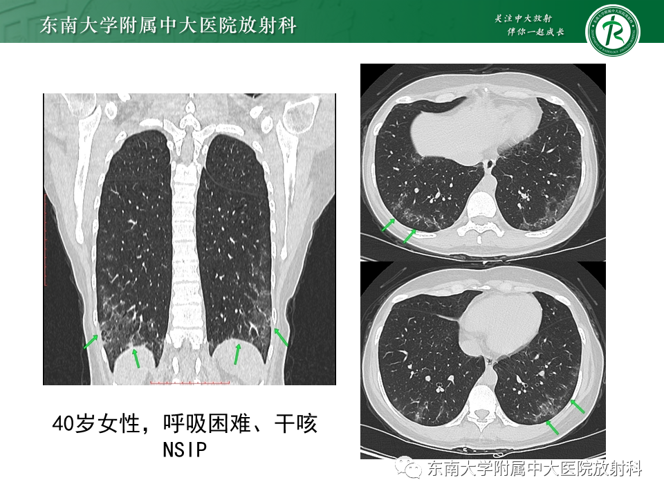 影像PPT - 【PPT】原发性干燥综合征的肺部改变-19 影像PPT - 【PPT】原发性干燥综合征的肺部改变-19