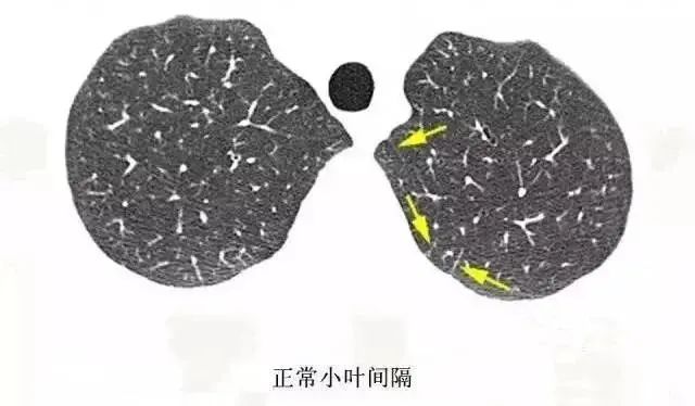 影像PPT - 次级肺小叶相关疾病与CT影像征象-8 影像PPT - 次级肺小叶相关疾病与CT影像征象-8