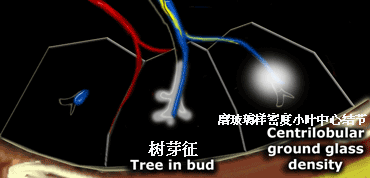 影像PPT - 次级肺小叶相关疾病与CT影像征象-3 影像PPT - 次级肺小叶相关疾病与CT影像征象-3