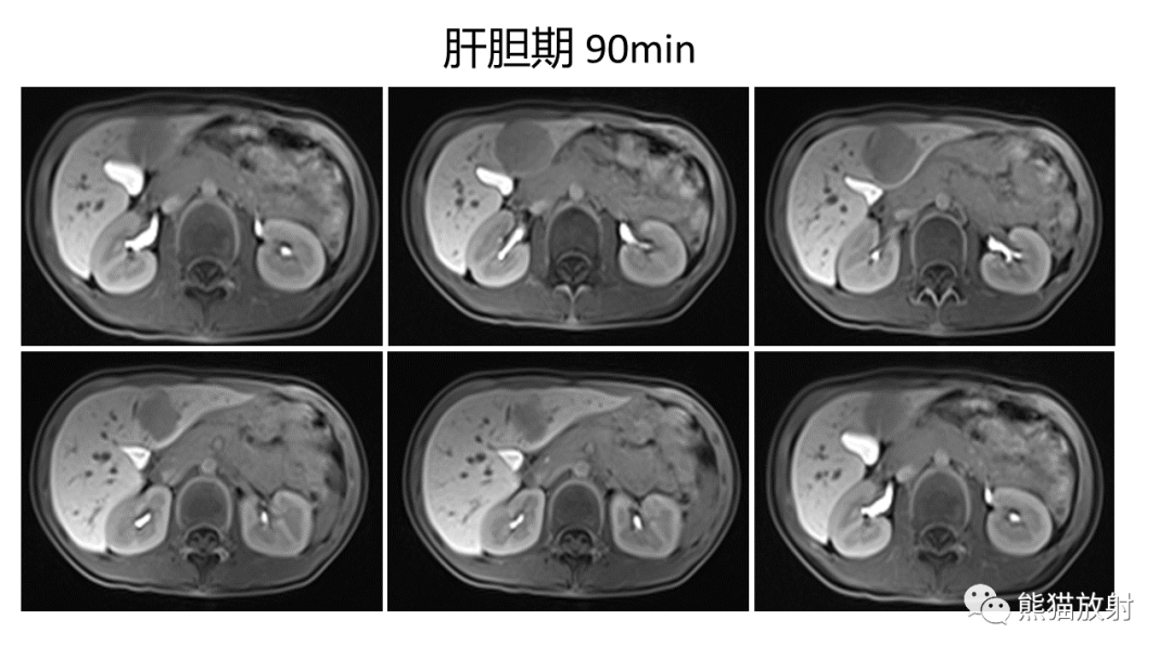 影像PPT - 【病例】局灶性结节性增生FNH VS 纤维板层型肝癌-24