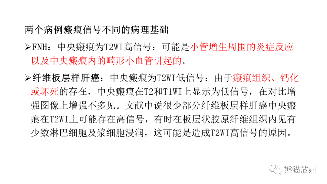 影像PPT - 【病例】局灶性结节性增生FNH VS 纤维板层型肝癌-30