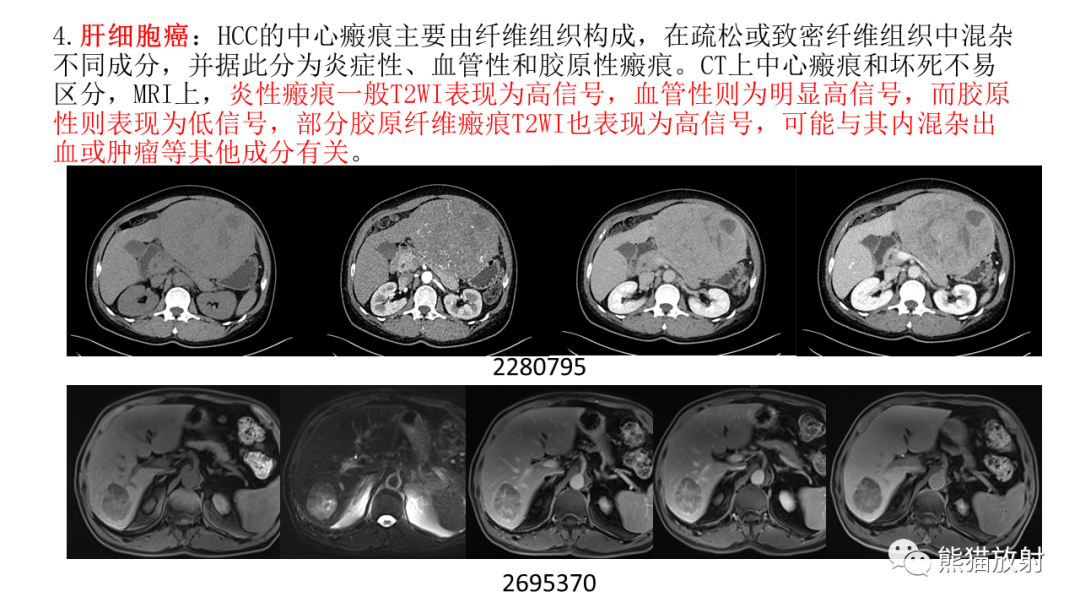 影像PPT - 【病例】局灶性结节性增生FNH VS 纤维板层型肝癌-35