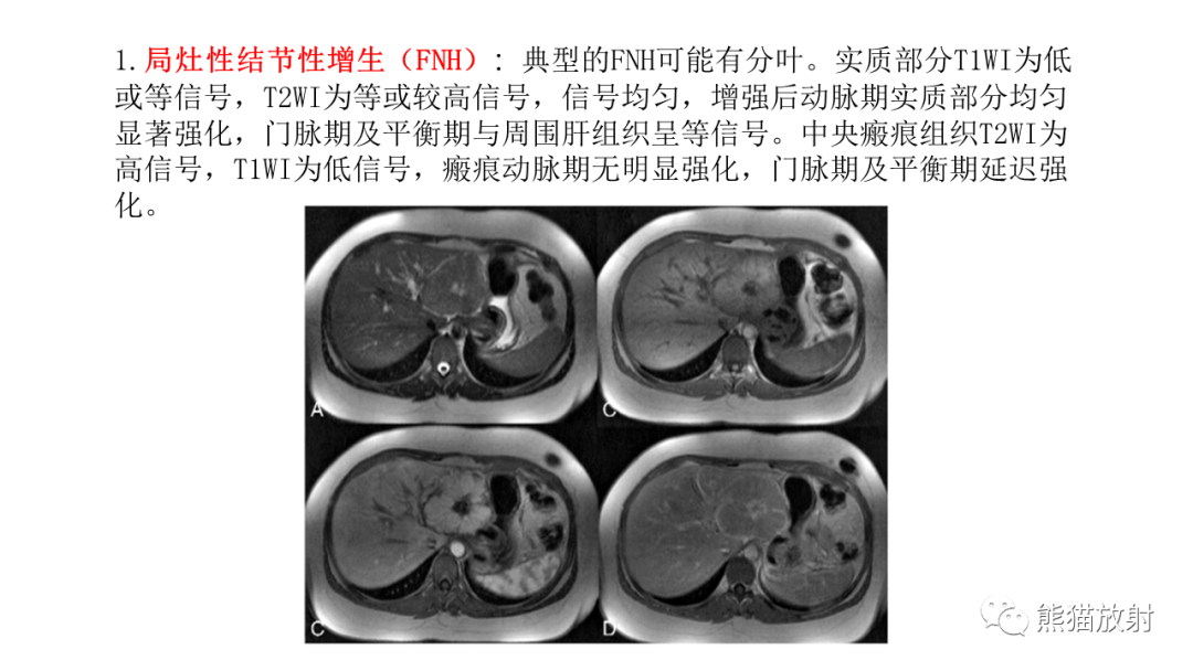 影像PPT - 【病例】局灶性结节性增生FNH VS 纤维板层型肝癌-32