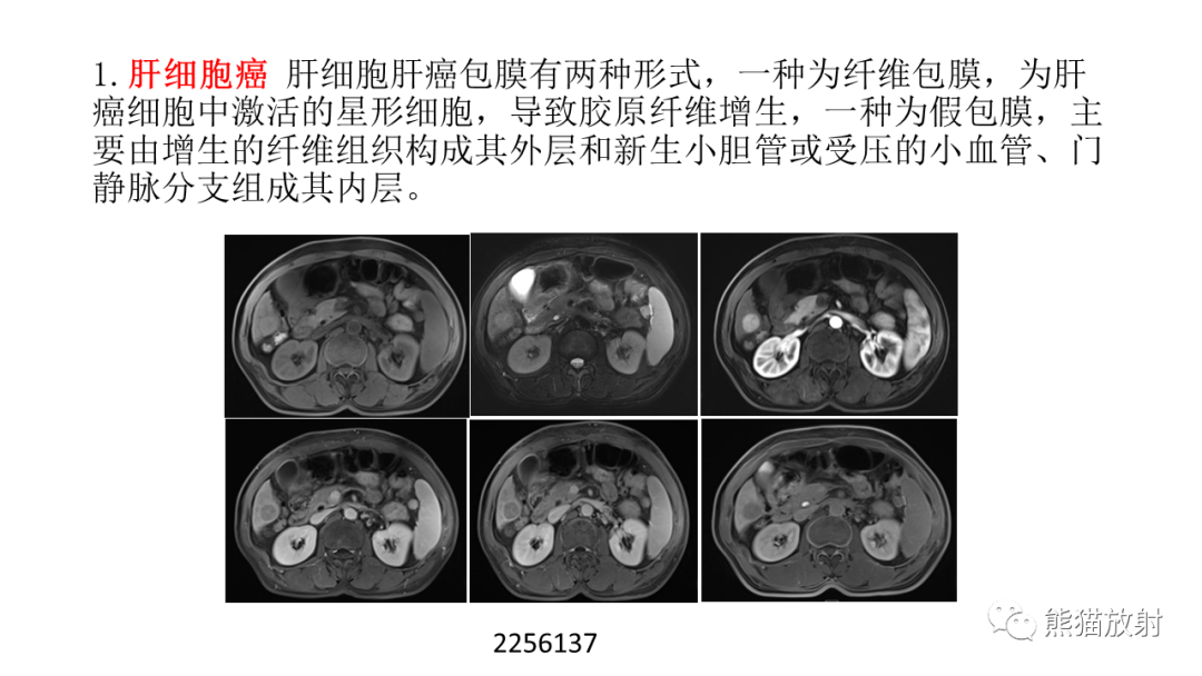 影像PPT - 【病例】局灶性结节性增生FNH VS 纤维板层型肝癌-38