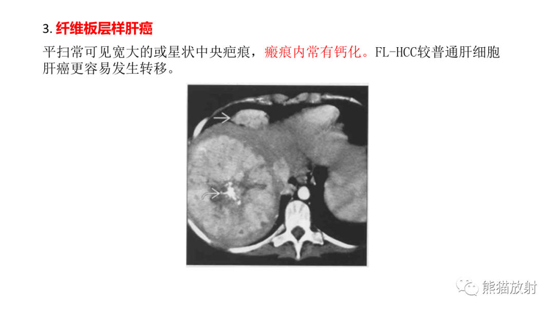 影像PPT - 【病例】局灶性结节性增生FNH VS 纤维板层型肝癌-3