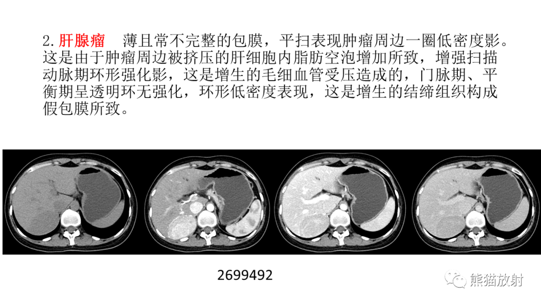 影像PPT - 【病例】局灶性结节性增生FNH VS 纤维板层型肝癌-4