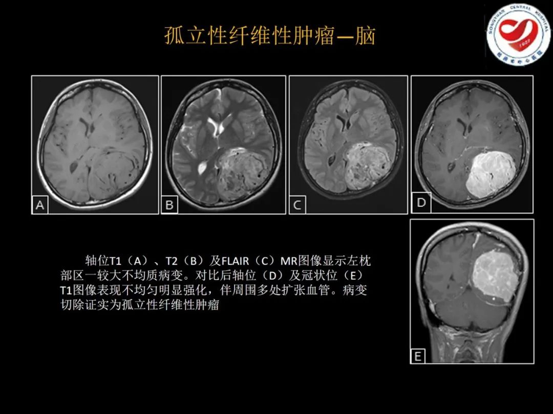 影像PPT - 【PPT】全身各部位孤立性纤维性肿瘤的临床及影像学特征-14