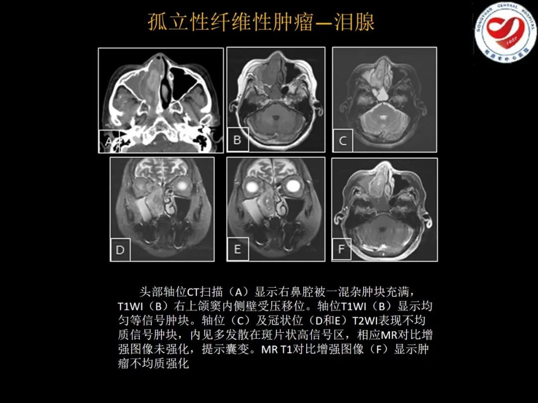 影像PPT - 【PPT】全身各部位孤立性纤维性肿瘤的临床及影像学特征-16