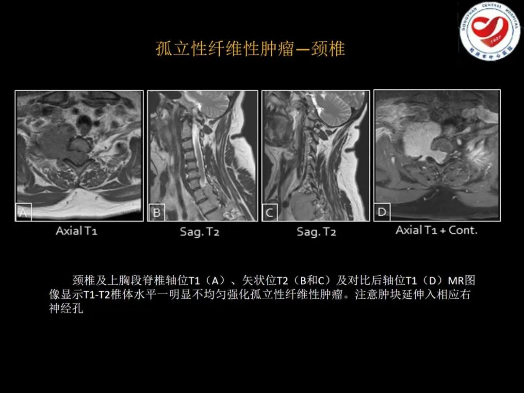 影像PPT - 【PPT】全身各部位孤立性纤维性肿瘤的临床及影像学特征-17