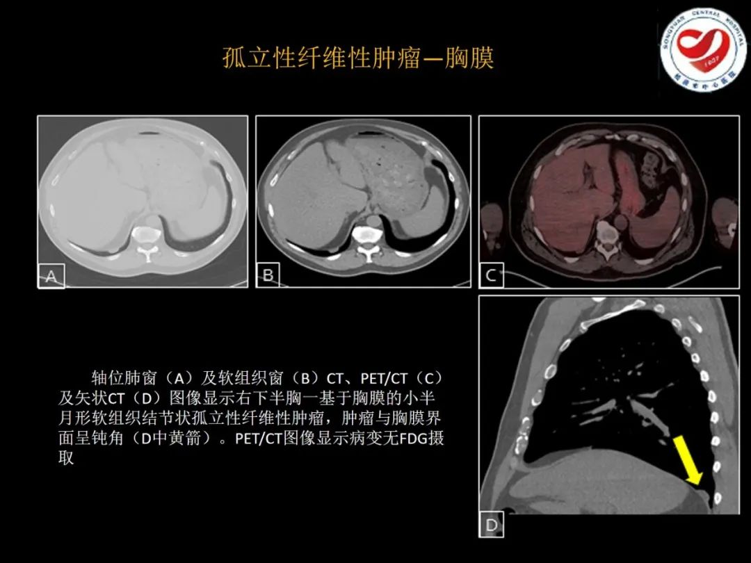 影像PPT - 【PPT】全身各部位孤立性纤维性肿瘤的临床及影像学特征-21