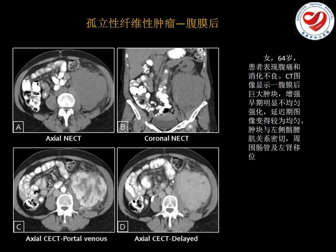 影像PPT - 【PPT】全身各部位孤立性纤维性肿瘤的临床及影像学特征-24