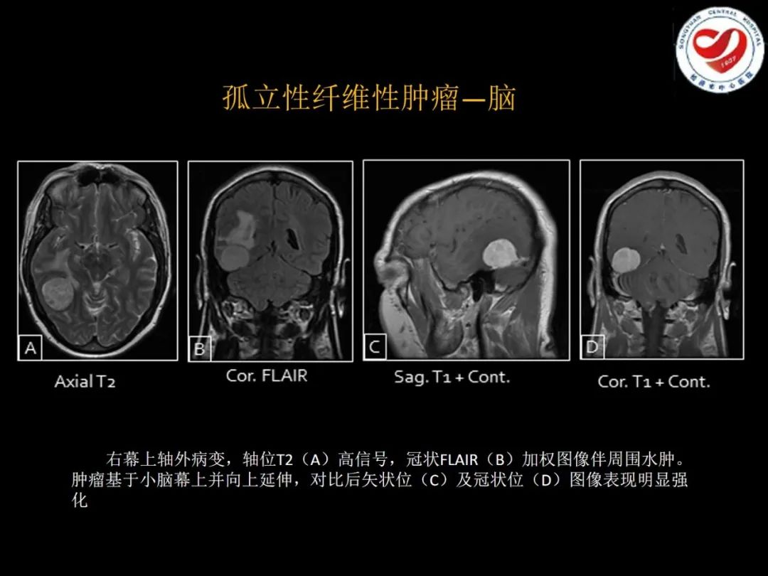 影像PPT - 【PPT】全身各部位孤立性纤维性肿瘤的临床及影像学特征-13