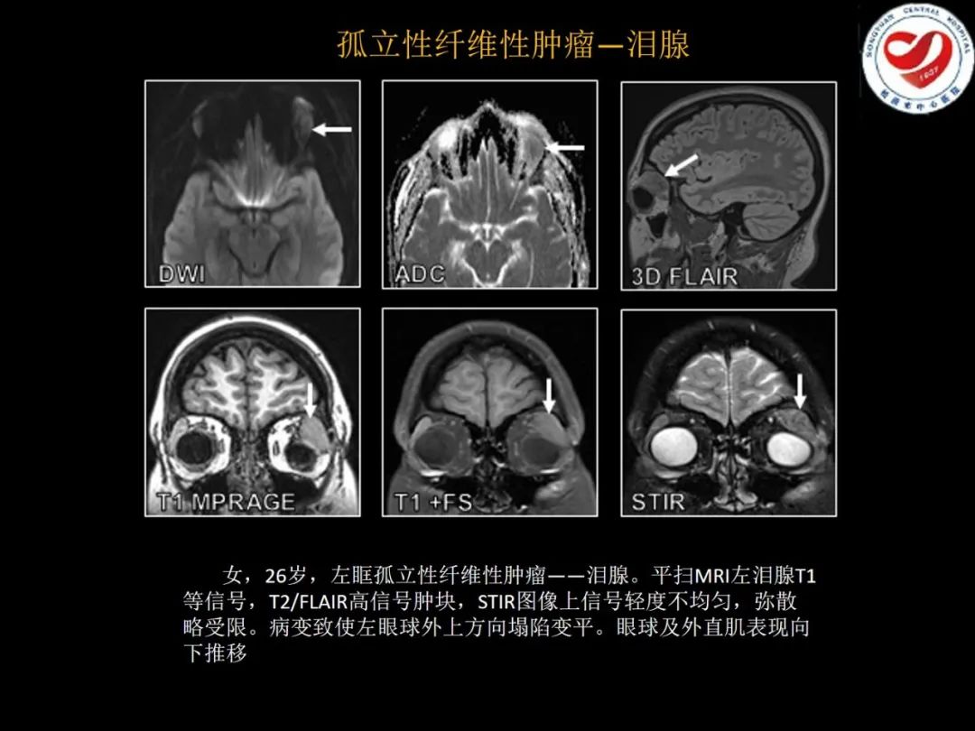 影像PPT - 【PPT】全身各部位孤立性纤维性肿瘤的临床及影像学特征-15