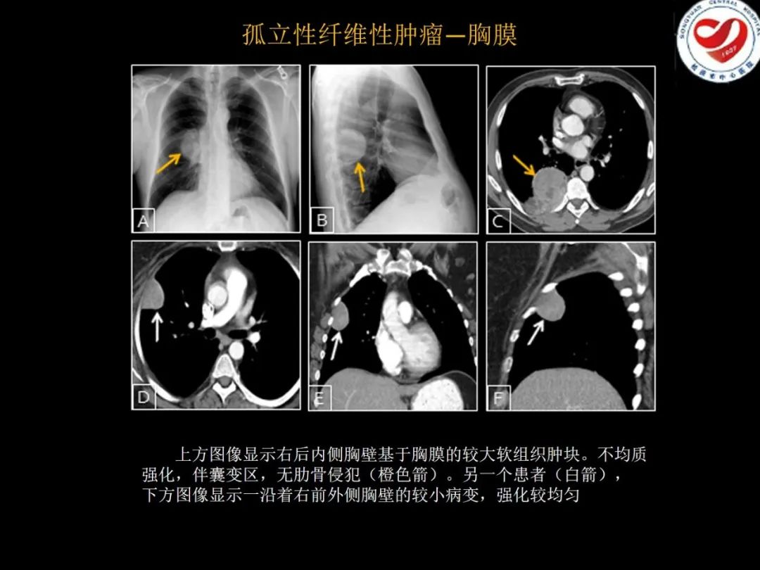 影像PPT - 【PPT】全身各部位孤立性纤维性肿瘤的临床及影像学特征-20