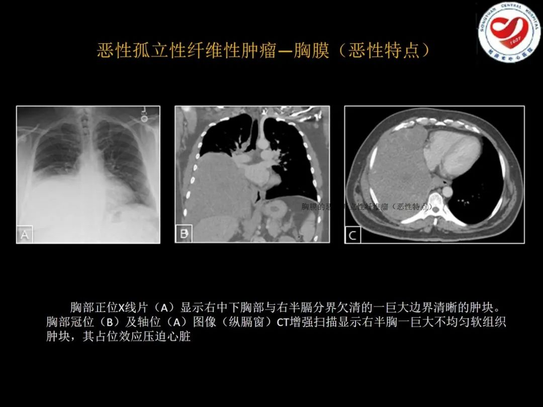 影像PPT - 【PPT】全身各部位孤立性纤维性肿瘤的临床及影像学特征-22