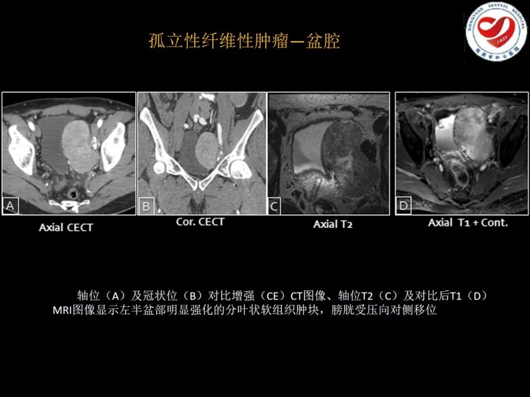 影像PPT - 【PPT】全身各部位孤立性纤维性肿瘤的临床及影像学特征-28