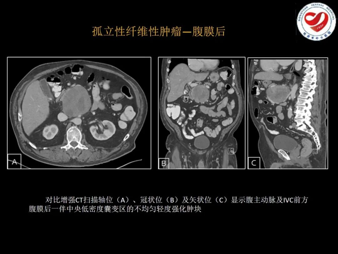 影像PPT - 【PPT】全身各部位孤立性纤维性肿瘤的临床及影像学特征-25