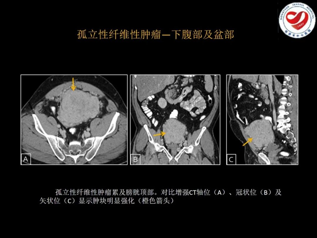 影像PPT - 【PPT】全身各部位孤立性纤维性肿瘤的临床及影像学特征-26