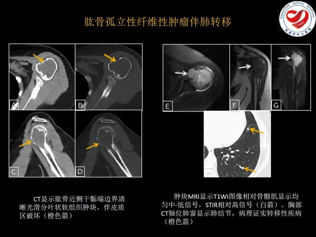 影像PPT - 【PPT】全身各部位孤立性纤维性肿瘤的临床及影像学特征-31