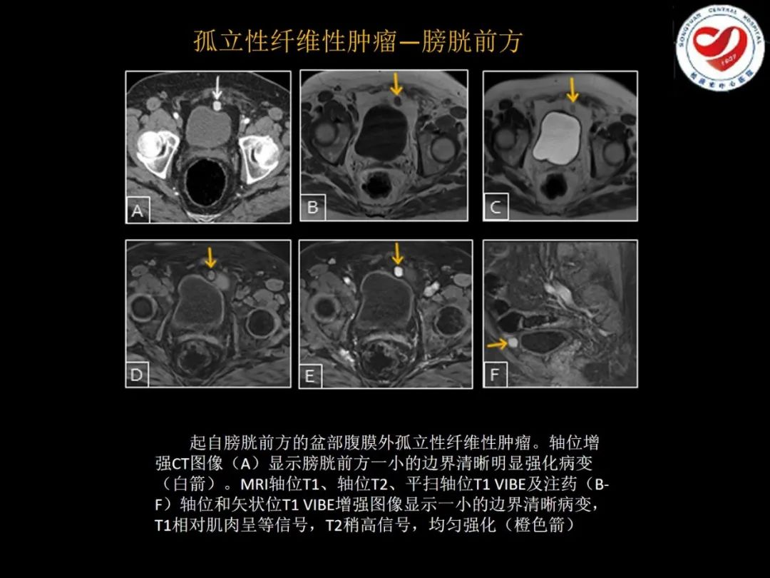 影像PPT - 【PPT】全身各部位孤立性纤维性肿瘤的临床及影像学特征-27