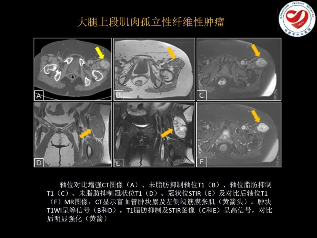影像PPT - 【PPT】全身各部位孤立性纤维性肿瘤的临床及影像学特征-33