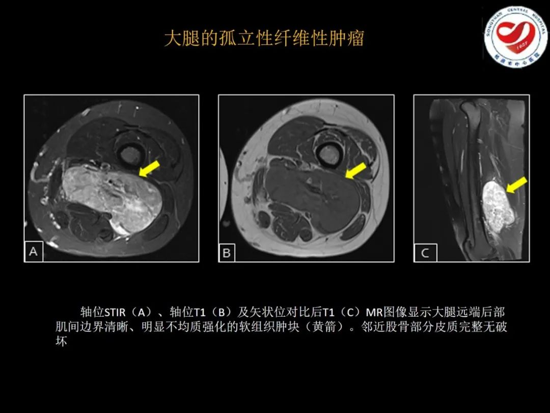 影像PPT - 【PPT】全身各部位孤立性纤维性肿瘤的临床及影像学特征-34