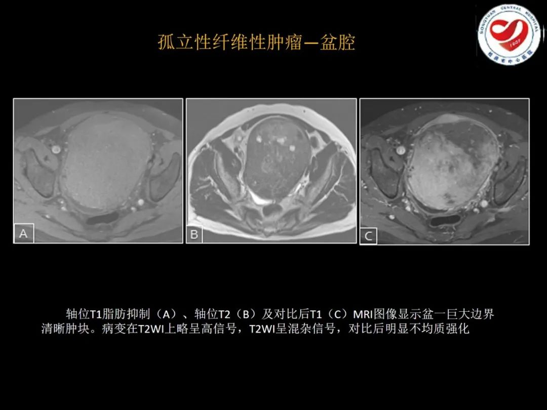 影像PPT - 【PPT】全身各部位孤立性纤维性肿瘤的临床及影像学特征-29