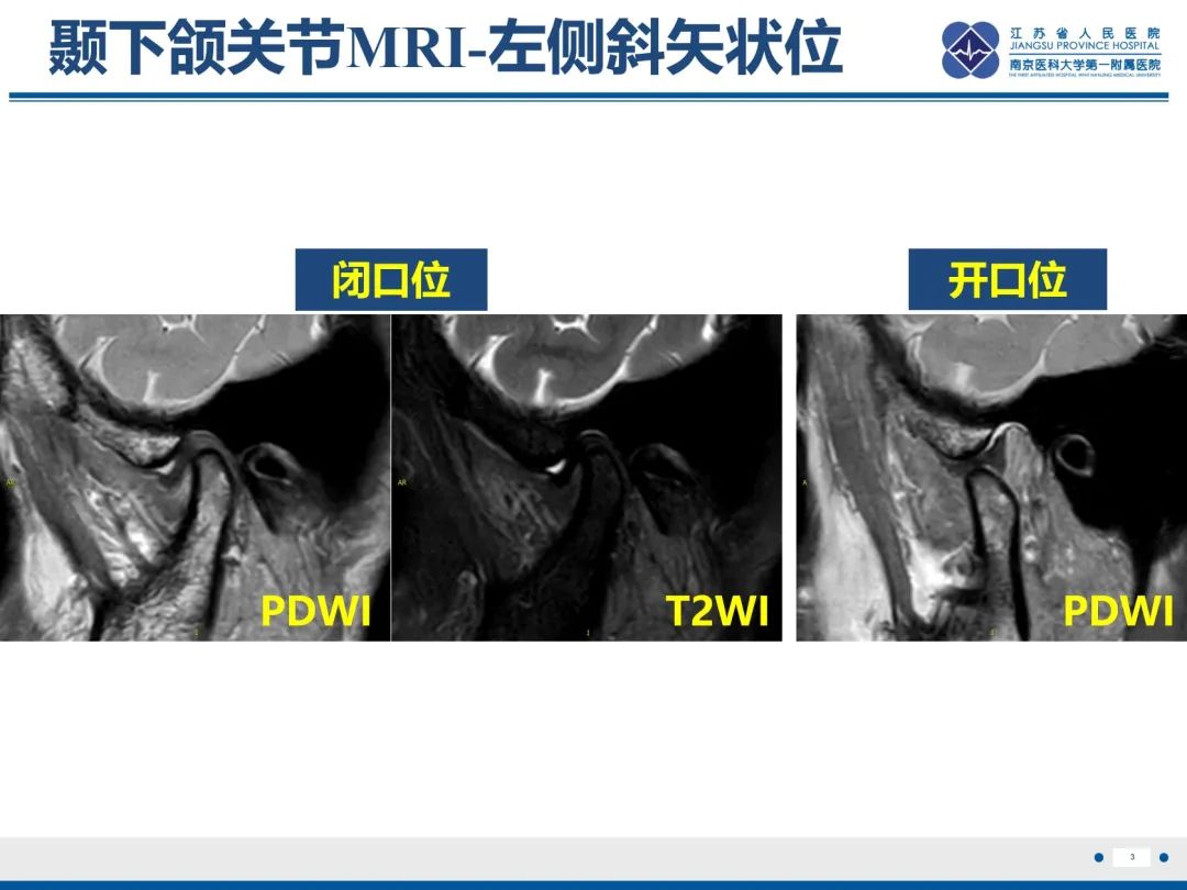 影像PPT - 【PPT】颞下颌关节紊乱病-4
