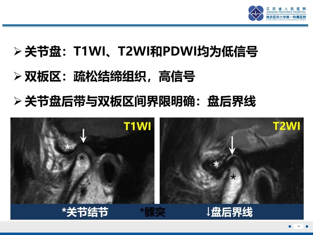影像PPT - 【PPT】颞下颌关节紊乱病-15
