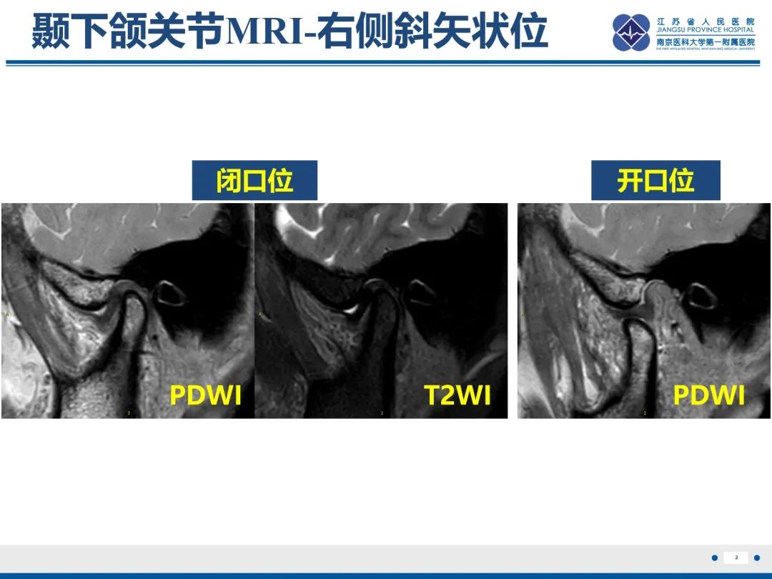 影像PPT - 【PPT】颞下颌关节紊乱病-3
