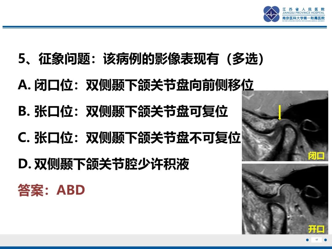 影像PPT - 【PPT】颞下颌关节紊乱病-18