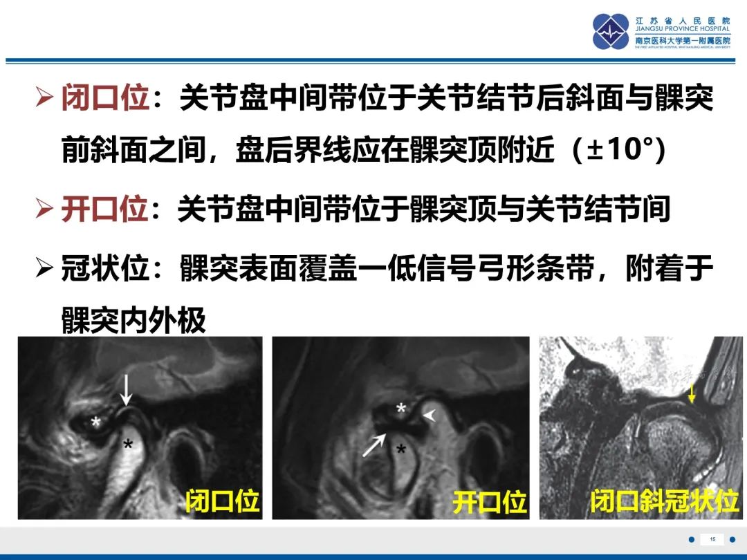 影像PPT - 【PPT】颞下颌关节紊乱病-16