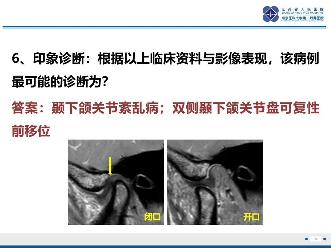 影像PPT - 【PPT】颞下颌关节紊乱病-20