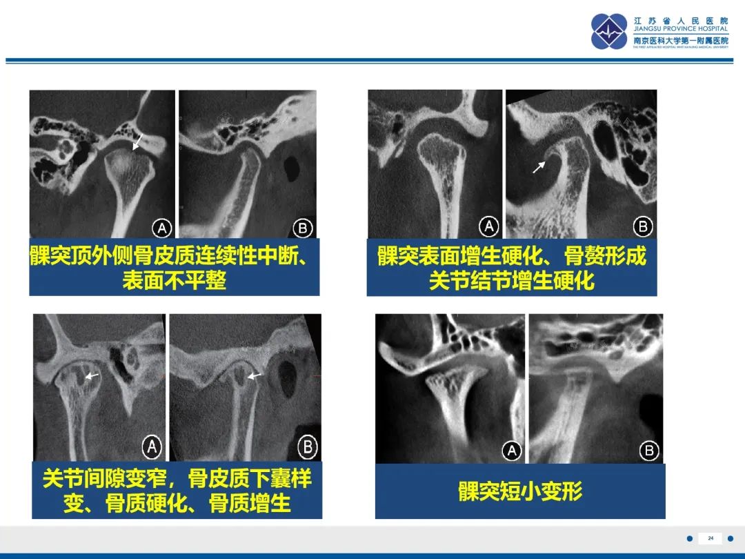 影像PPT - 【PPT】颞下颌关节紊乱病-25