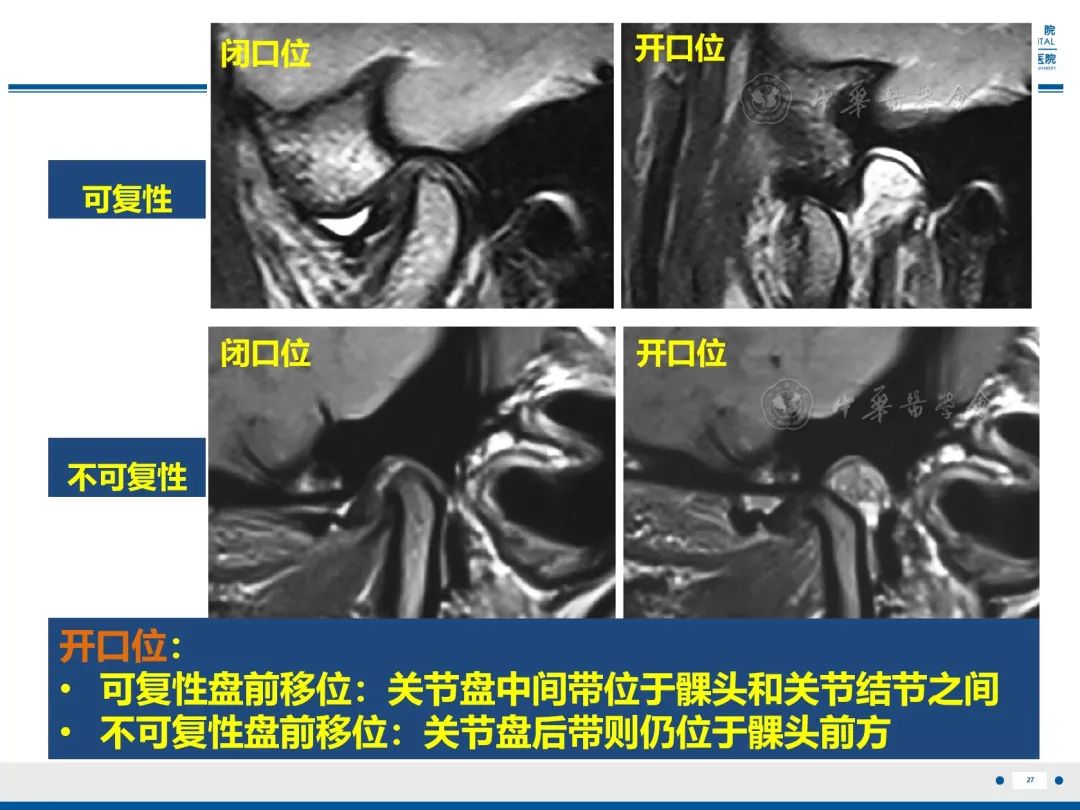 影像PPT - 【PPT】颞下颌关节紊乱病-28