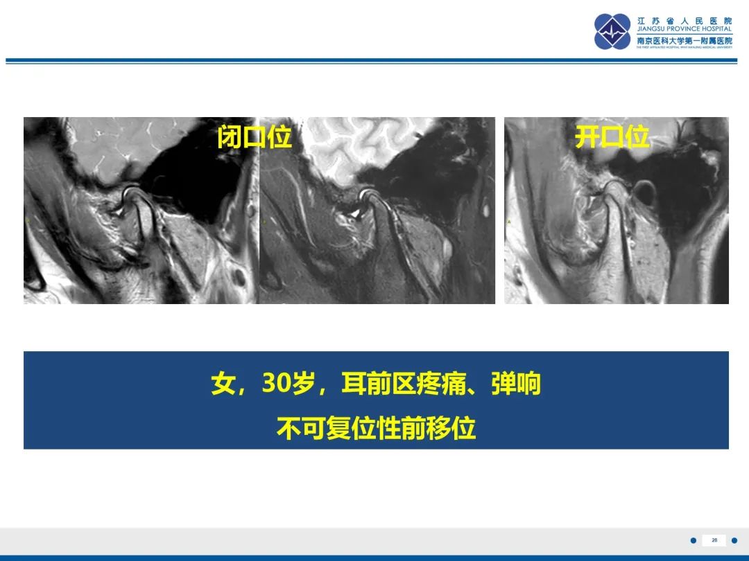 影像PPT - 【PPT】颞下颌关节紊乱病-29