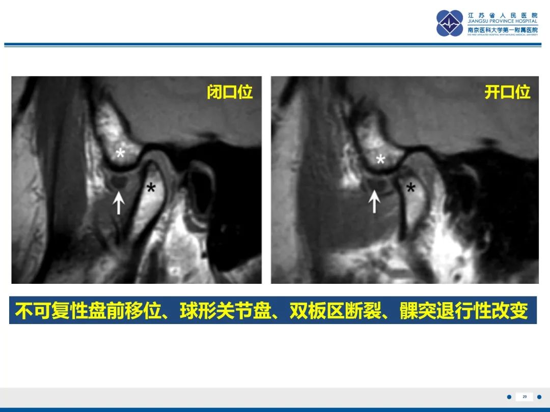 影像PPT - 【PPT】颞下颌关节紊乱病-30