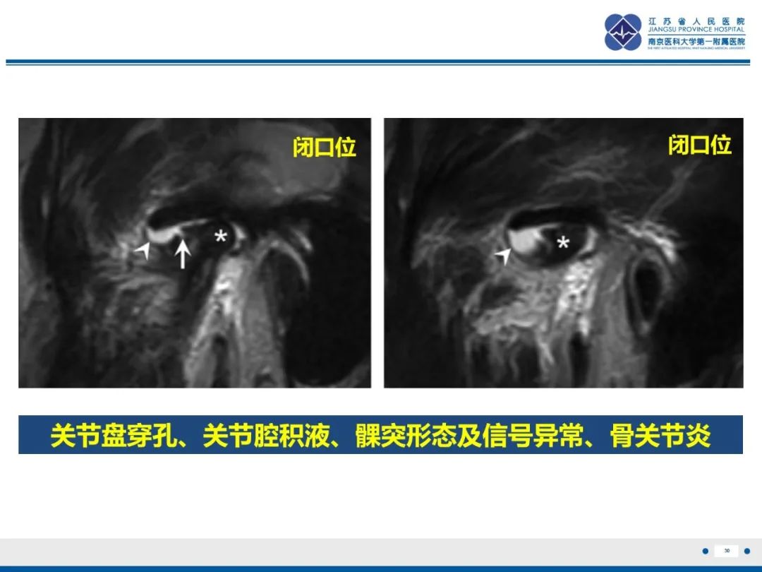 影像PPT - 【PPT】颞下颌关节紊乱病-31