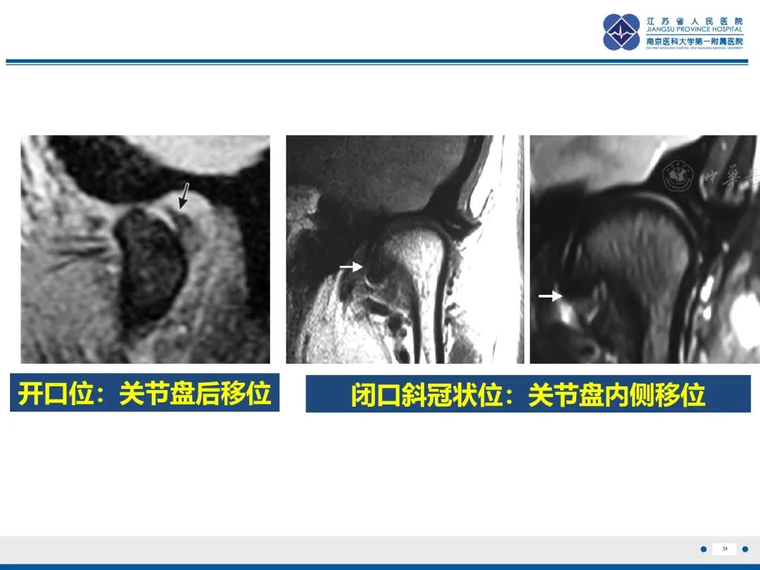 影像PPT - 【PPT】颞下颌关节紊乱病-32