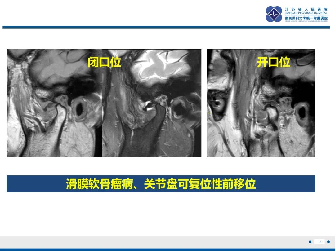 影像PPT - 【PPT】颞下颌关节紊乱病-34