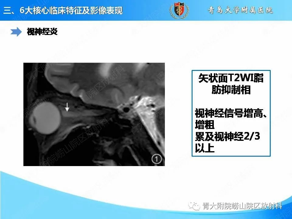 影像PPT - 【PPT】视神经脊髓炎谱系疾病的影像学诊断与鉴别诊断-8