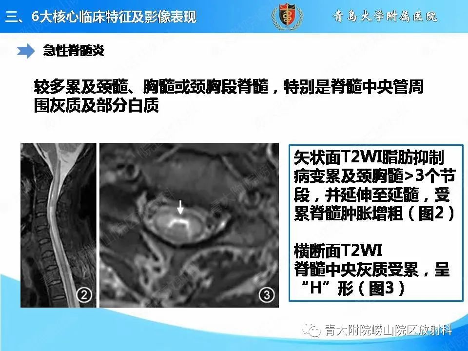 影像PPT - 【PPT】视神经脊髓炎谱系疾病的影像学诊断与鉴别诊断-10