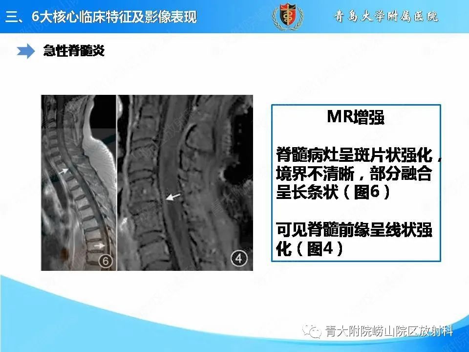 影像PPT - 【PPT】视神经脊髓炎谱系疾病的影像学诊断与鉴别诊断-12