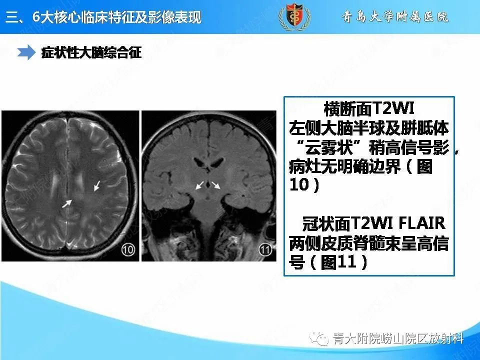 影像PPT - 【PPT】视神经脊髓炎谱系疾病的影像学诊断与鉴别诊断-19