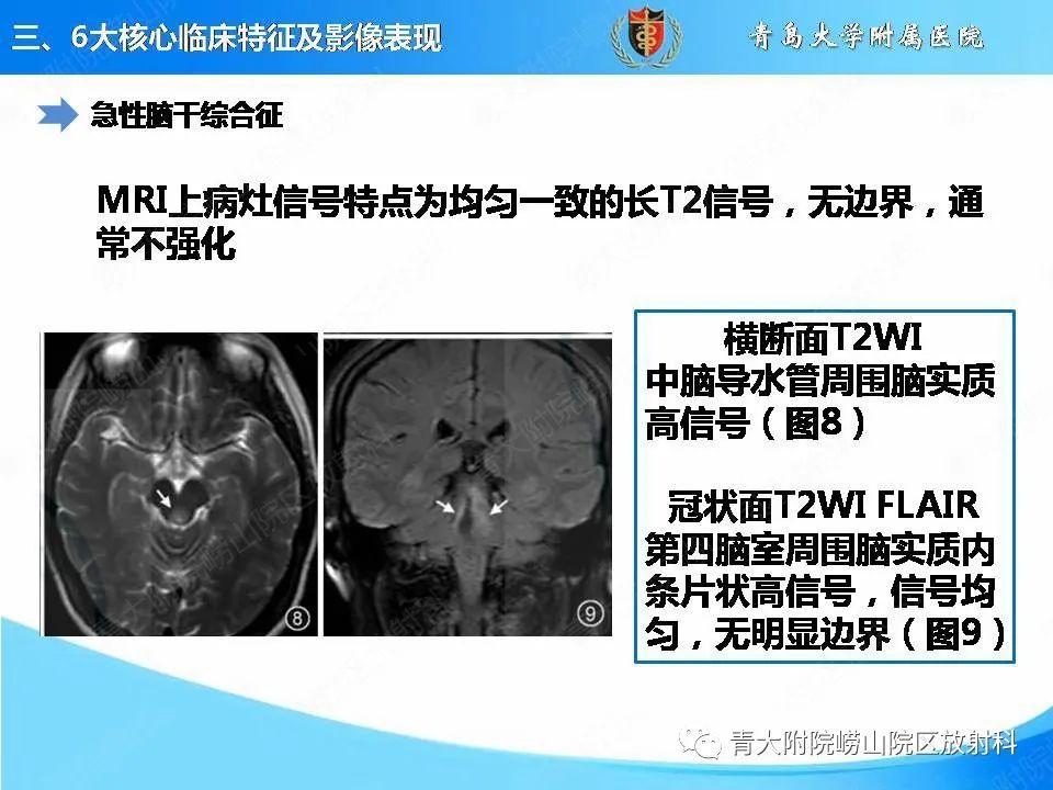 影像PPT - 【PPT】视神经脊髓炎谱系疾病的影像学诊断与鉴别诊断-16